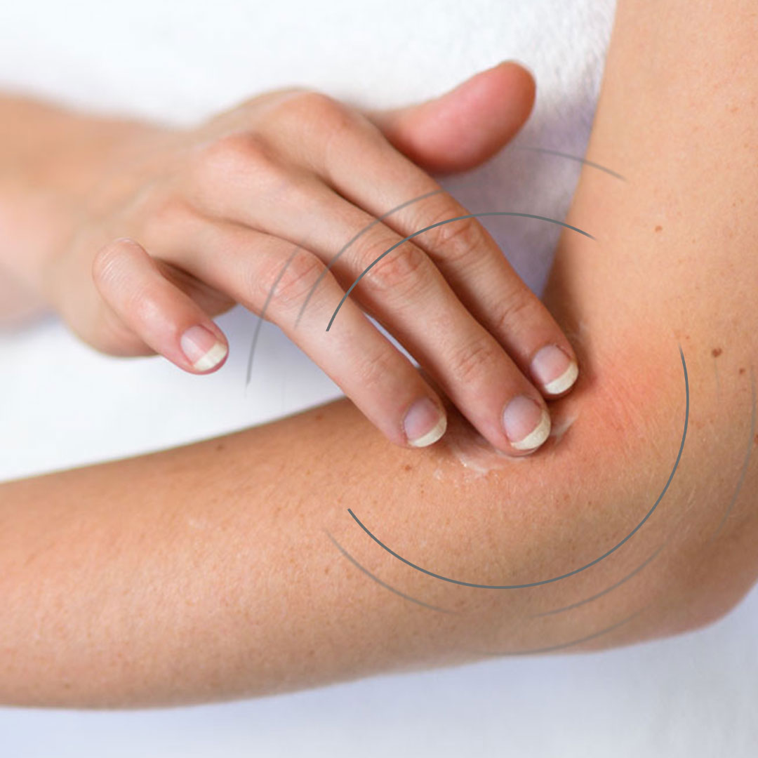 Geprikkelde huid: hoe kan Synofit Skin Care helpen?